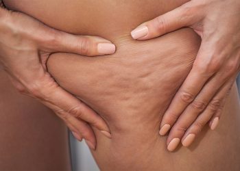 Celulitis en el embarazo: trucos para evitarla