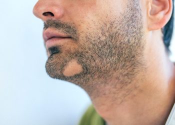 Te contamos en este artículo de Primor todo lo que debes saber sobre la alopecia areata de la barba