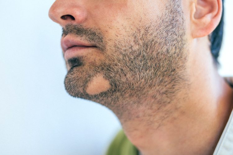 Te contamos en este artículo de Primor todo lo que debes saber sobre la alopecia areata de la barba