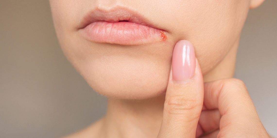 Cómo eliminar el herpes labial