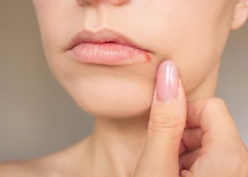 Cómo eliminar el herpes labial