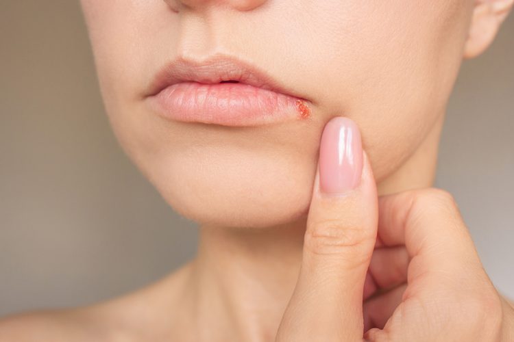 Cómo eliminar el herpes labial