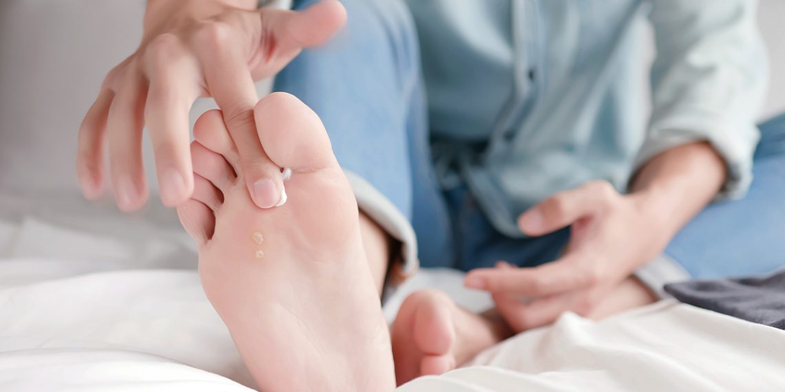 Psoriasis en los pies: tratamientos