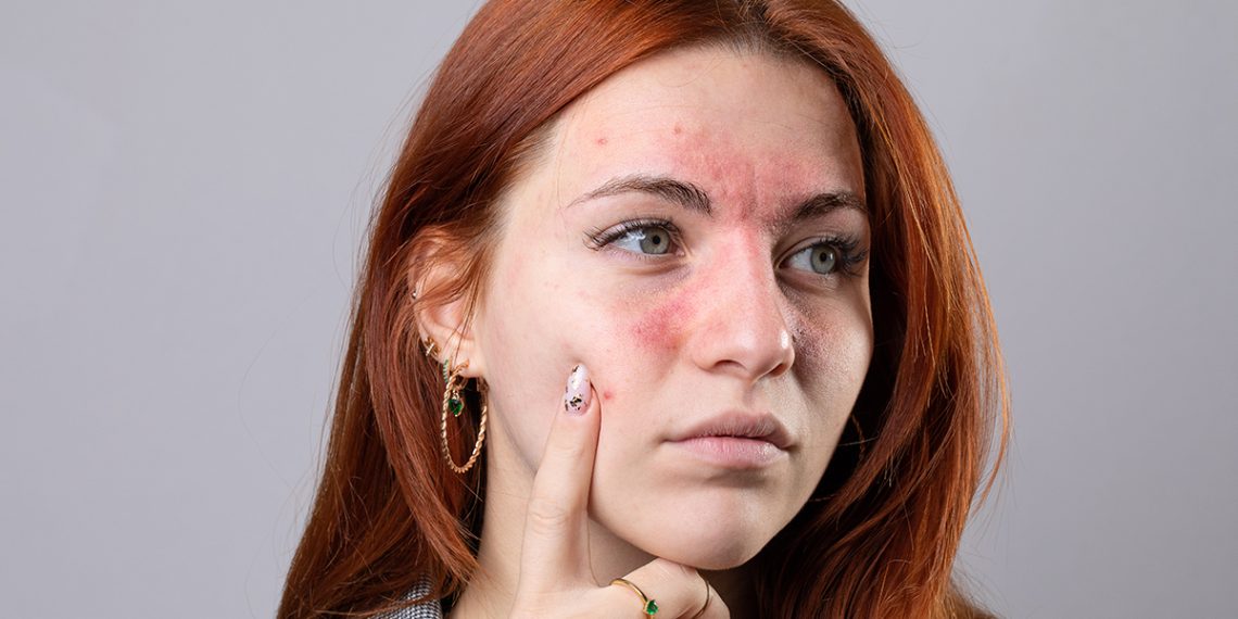 Te contamos cómo tratar la dermatitis seborreica en la cara.