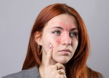 Te contamos cómo tratar la dermatitis seborreica en la cara.