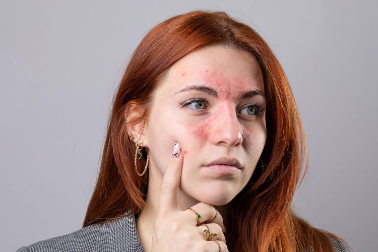 Te contamos cómo tratar la dermatitis seborreica en la cara.