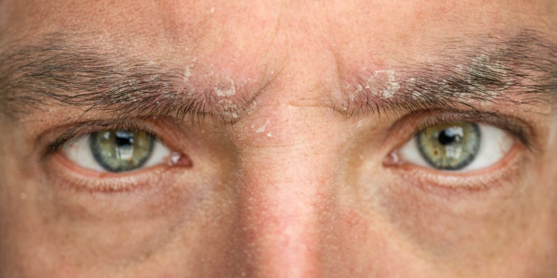 Dermatitis seborreica en las cejas: soluciones