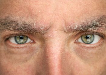 Dermatitis seborreica en las cejas: soluciones