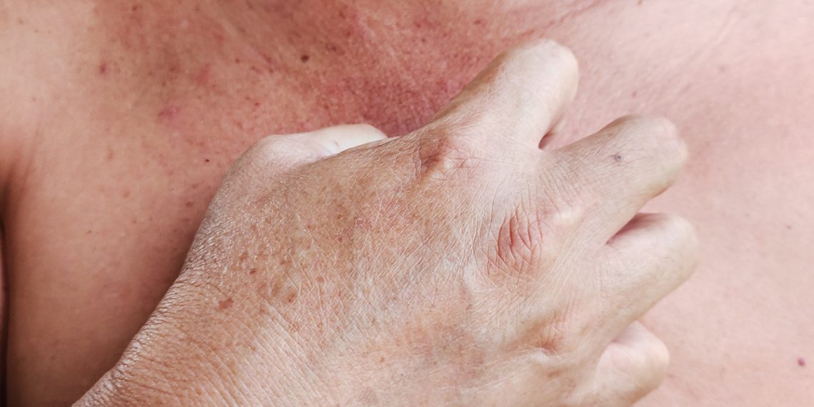 Te contamos cómo tratar la dermatitis seborreica en el pecho.