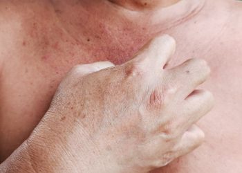 Te contamos cómo tratar la dermatitis seborreica en el pecho.