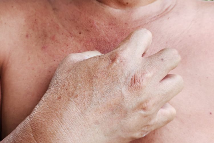 Te contamos cómo tratar la dermatitis seborreica en el pecho.