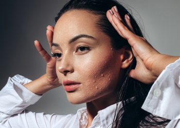 Te contamos qué es exactamente la hiperhidrosis facial.